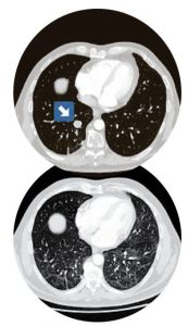 Dördüncü evre akciğer kanser hastasının Covid öncesi ve sonrası çekilen tomografisi